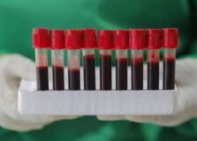 Novo exame de sangue consegue detectar 5 tipos de câncer precocemente