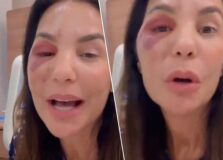 Ivete Sangalo surge após cirurgia, detalha procedimento e tranquiliza fãs